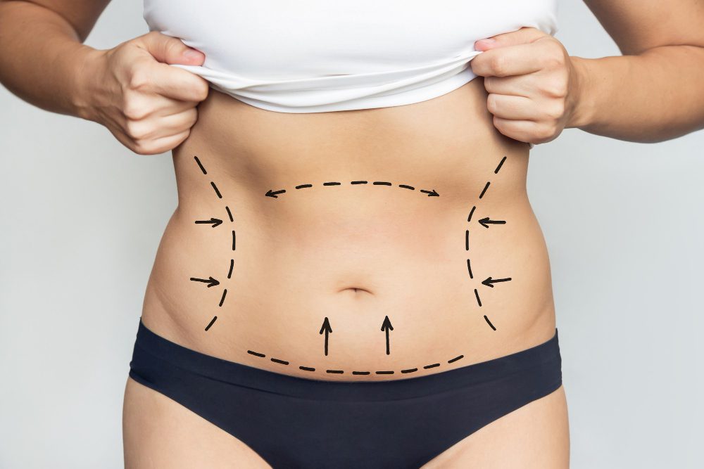 Milton Keynes Specialist in Lipedema Massage and Post-Surgical Care