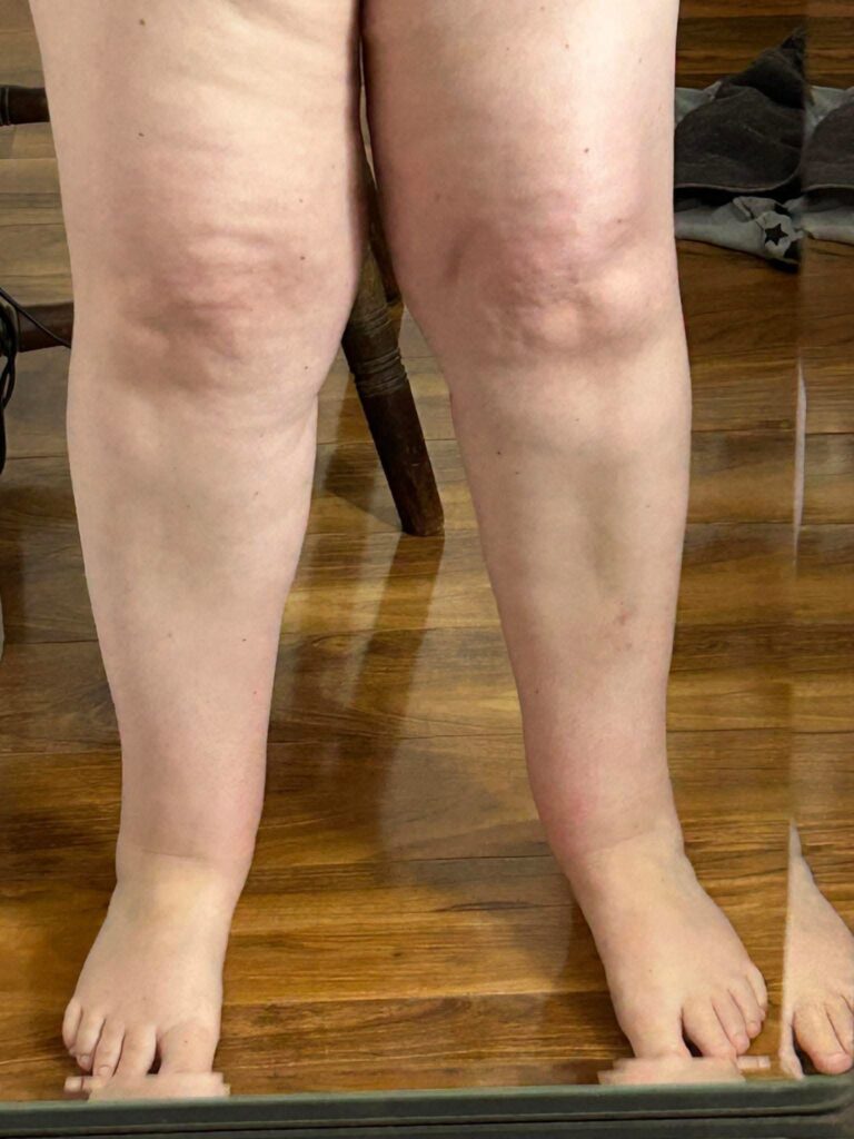 Lipedema Care in Milton Keynes